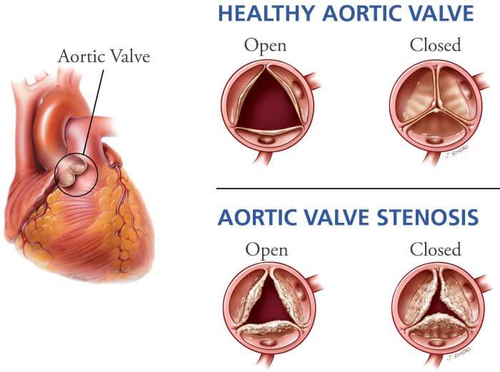 stenoza aortnog zaliska
