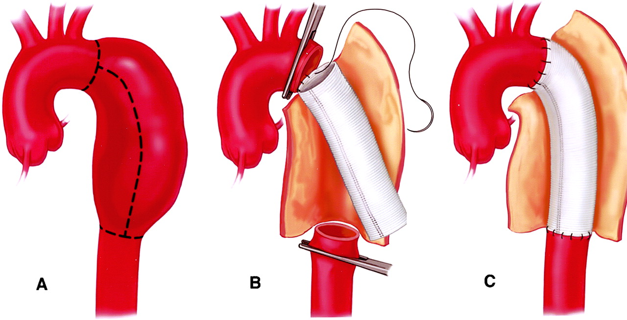 lečenje aneurizme aorte