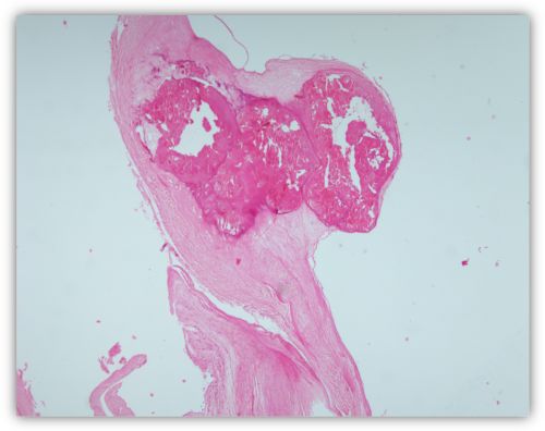 Kalcifikantna stenoza aortnog zaliska